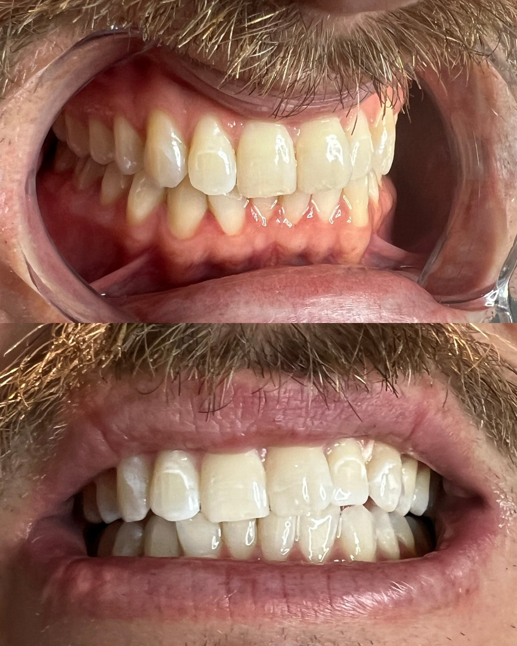 BLACK FRIDAY || TEETH WHITENING