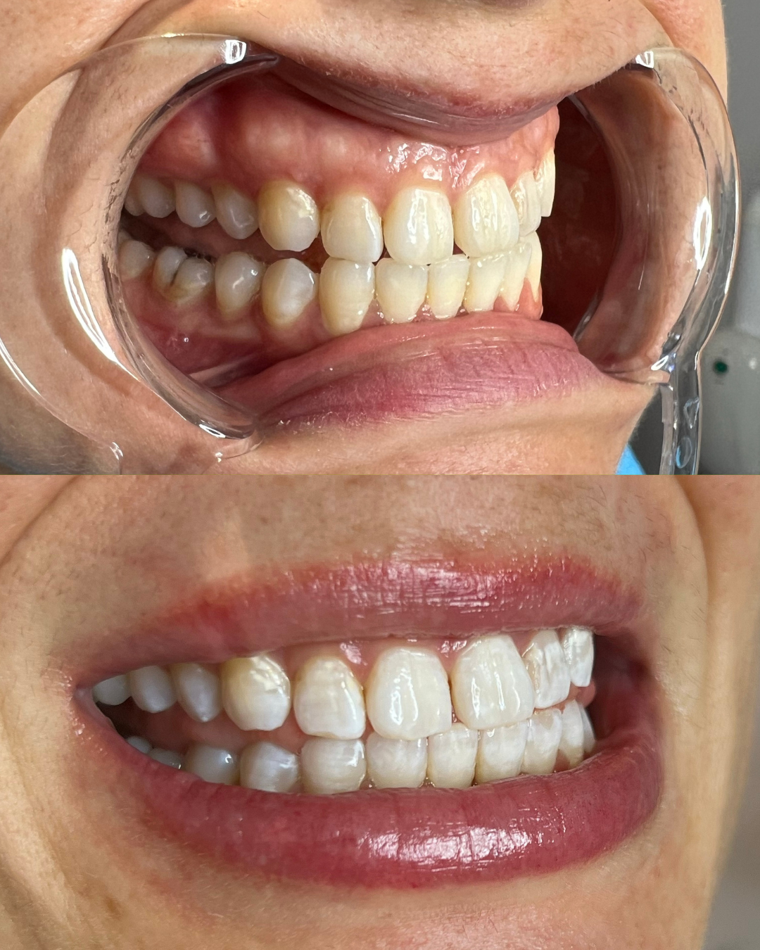 BLACK FRIDAY || TEETH WHITENING