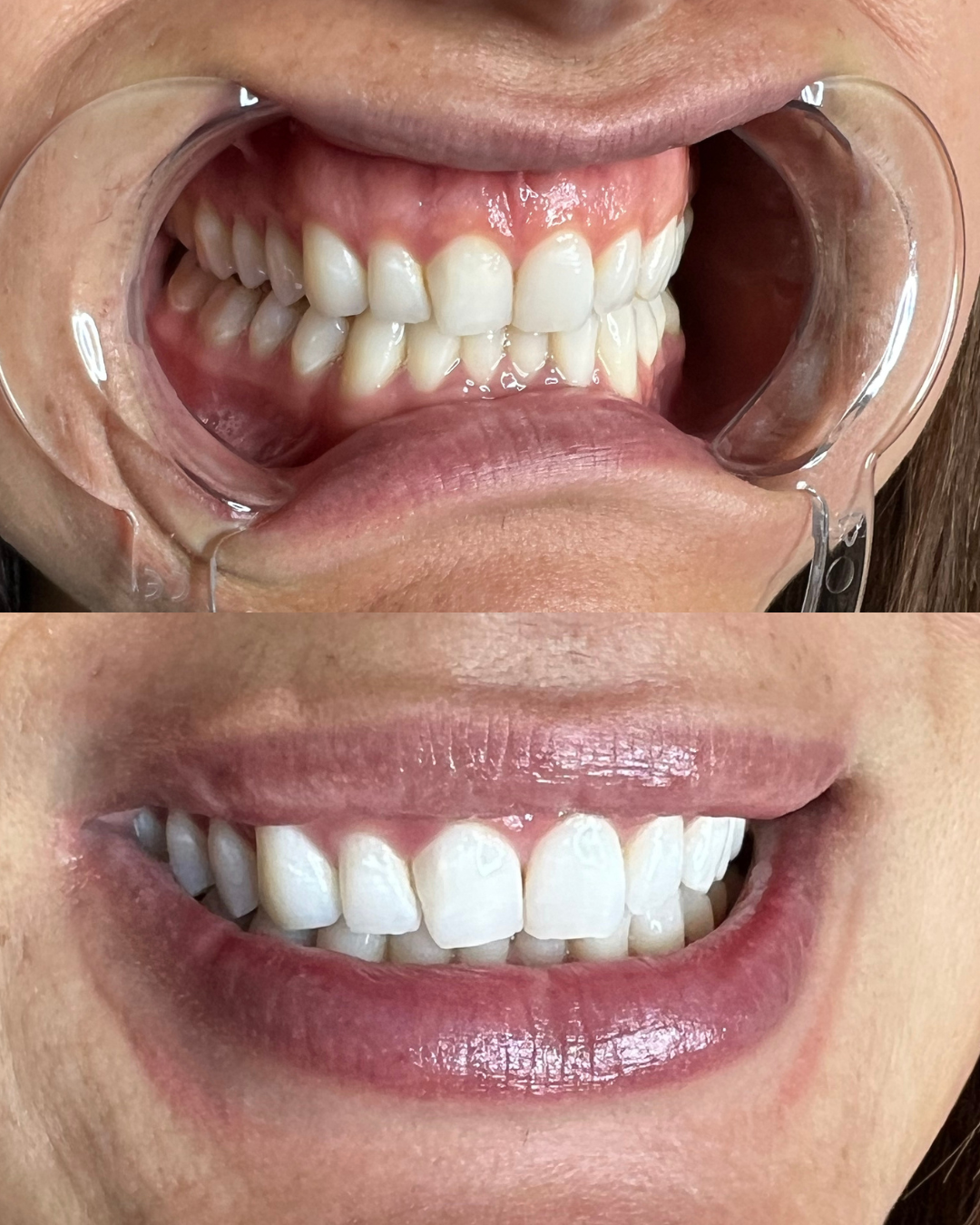 BLACK FRIDAY || TEETH WHITENING