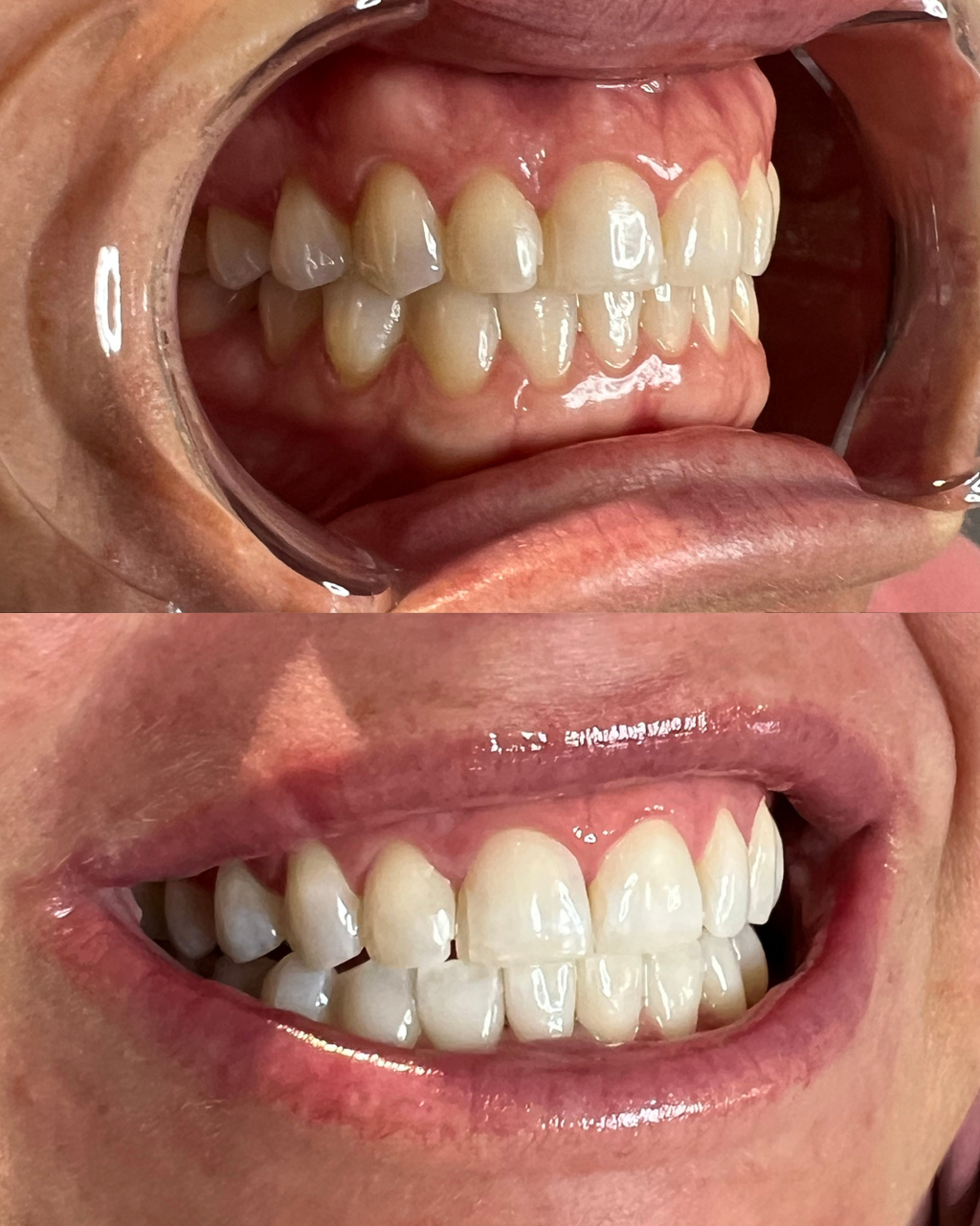 BLACK FRIDAY || TEETH WHITENING