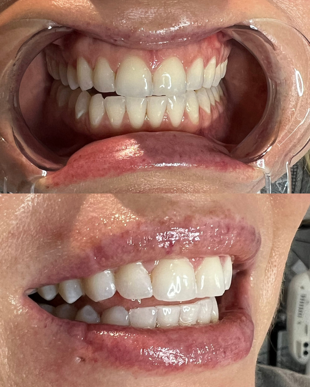 BLACK FRIDAY || TEETH WHITENING