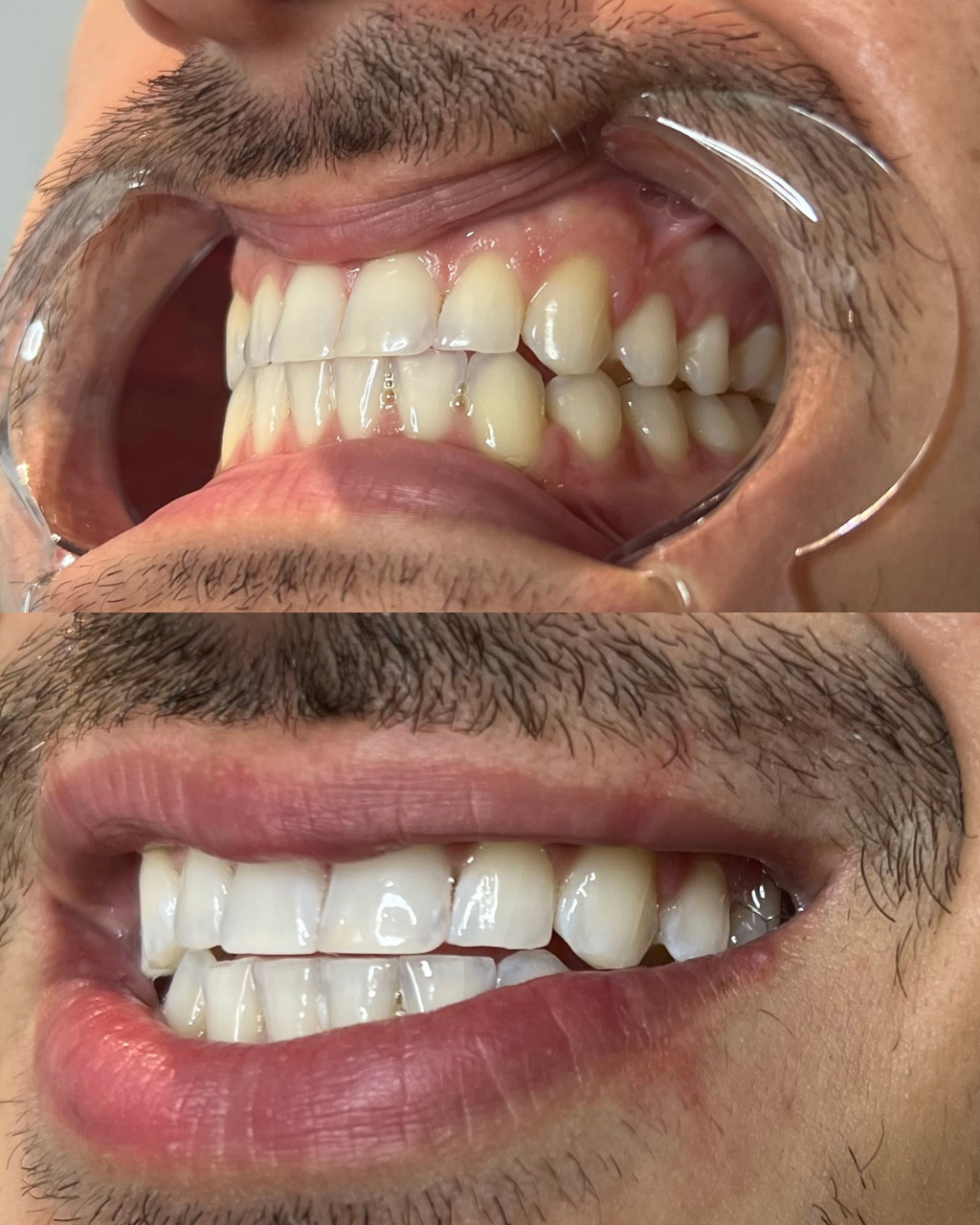 BLACK FRIDAY || TEETH WHITENING