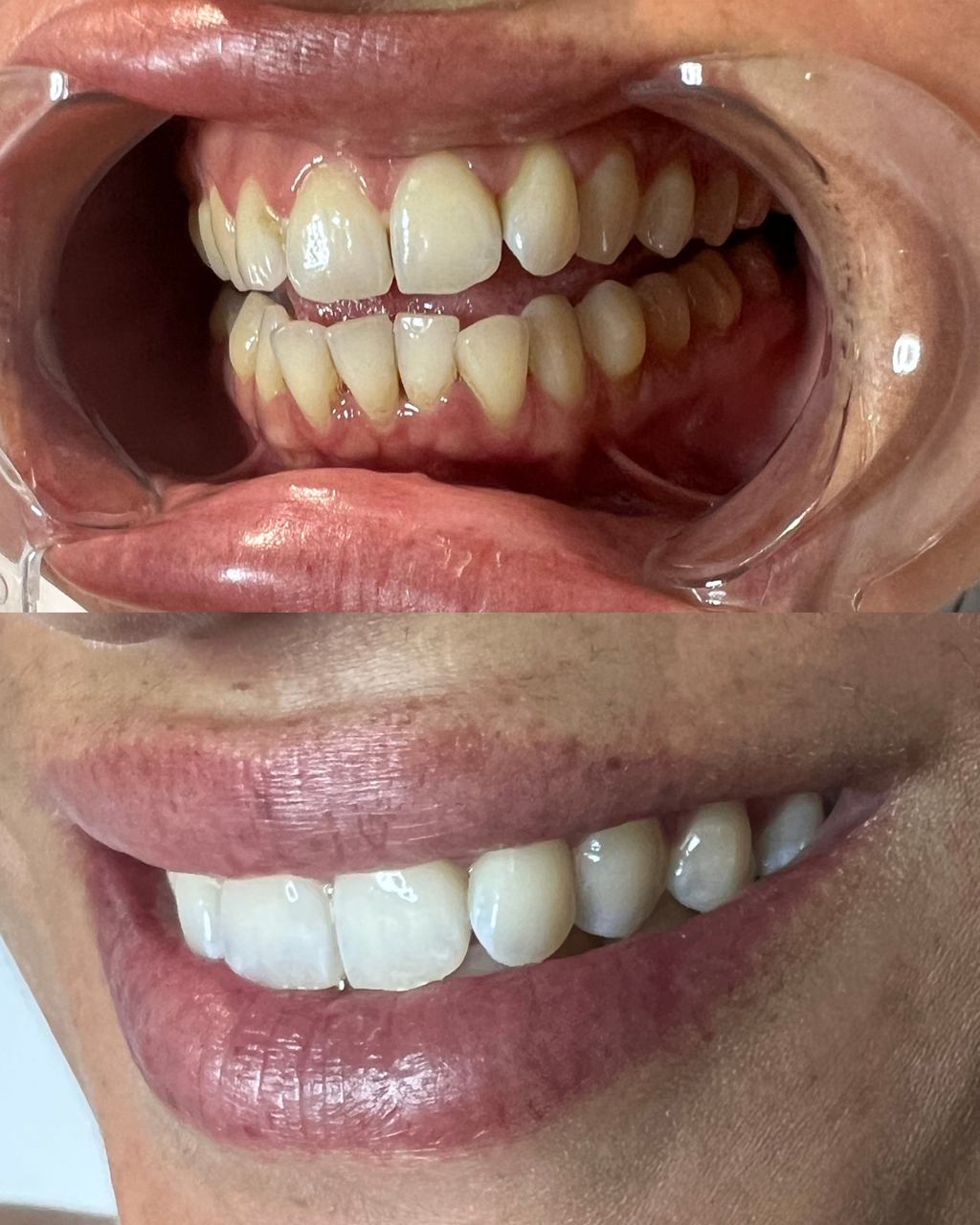 BLACK FRIDAY || TEETH WHITENING